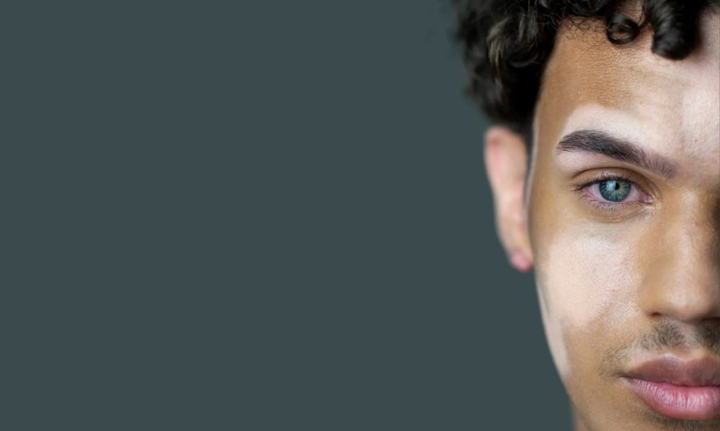 Homem com vitiligo Pele Rara