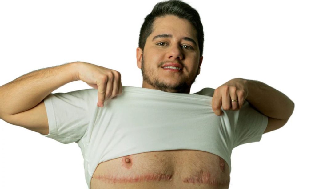 Divulgação Mastectomia